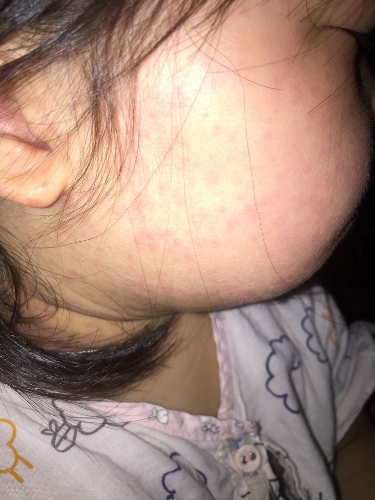 今天开始更加严重了.昨天医生说是病毒疹.我还是不放