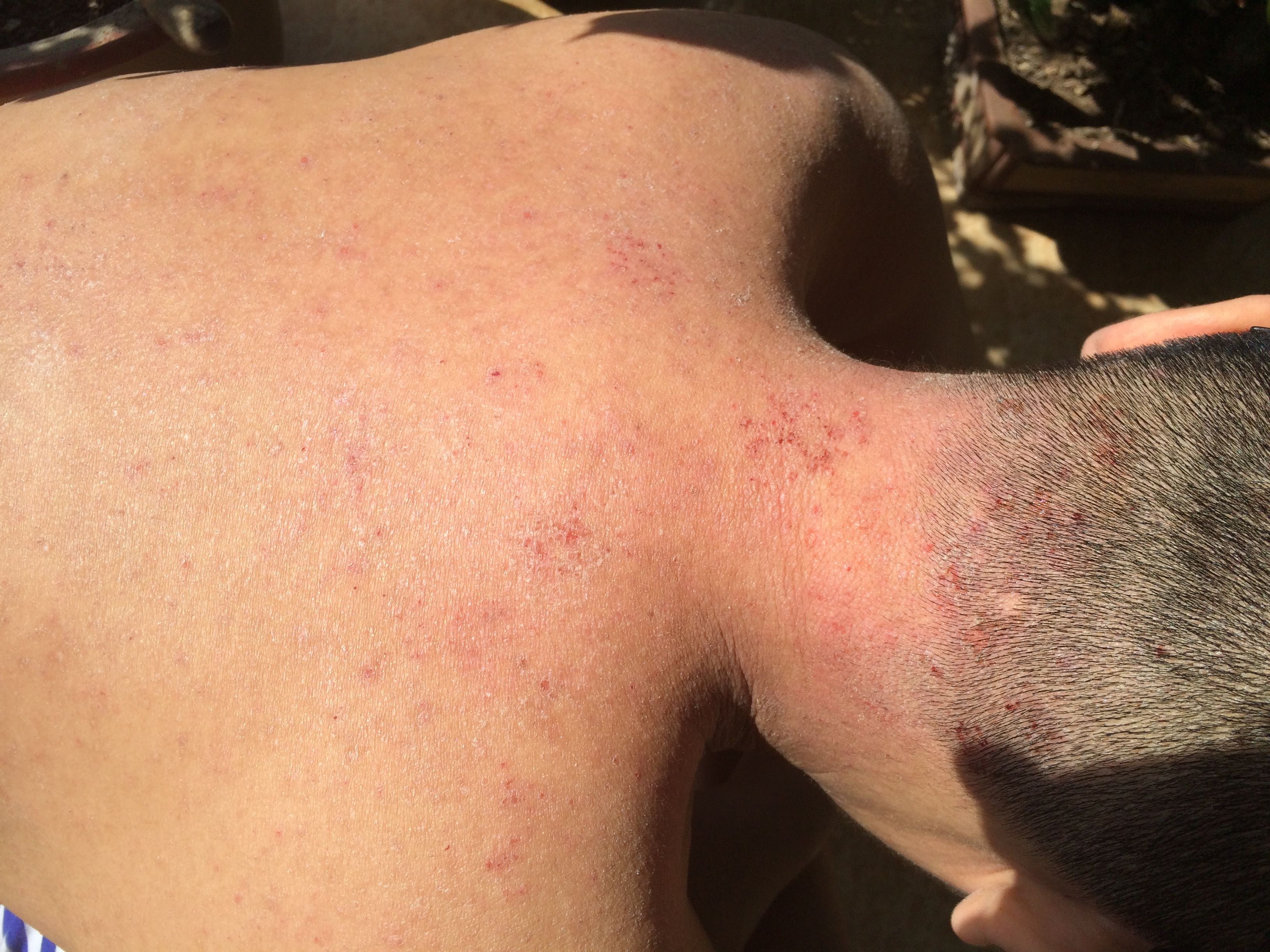 皮肤很痒然后自己挠成这个样子,皮肤还很干,请问这个是什么病?