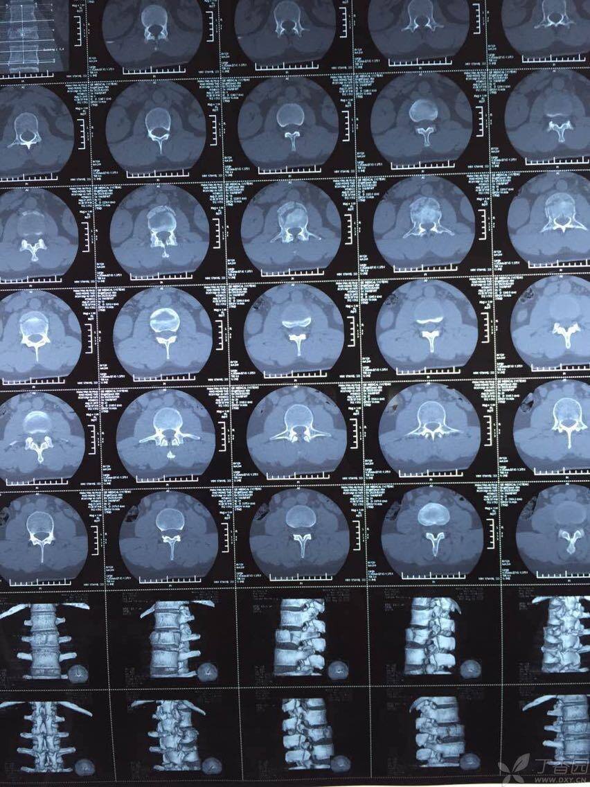 腰椎压缩骨折治疗?求大神!