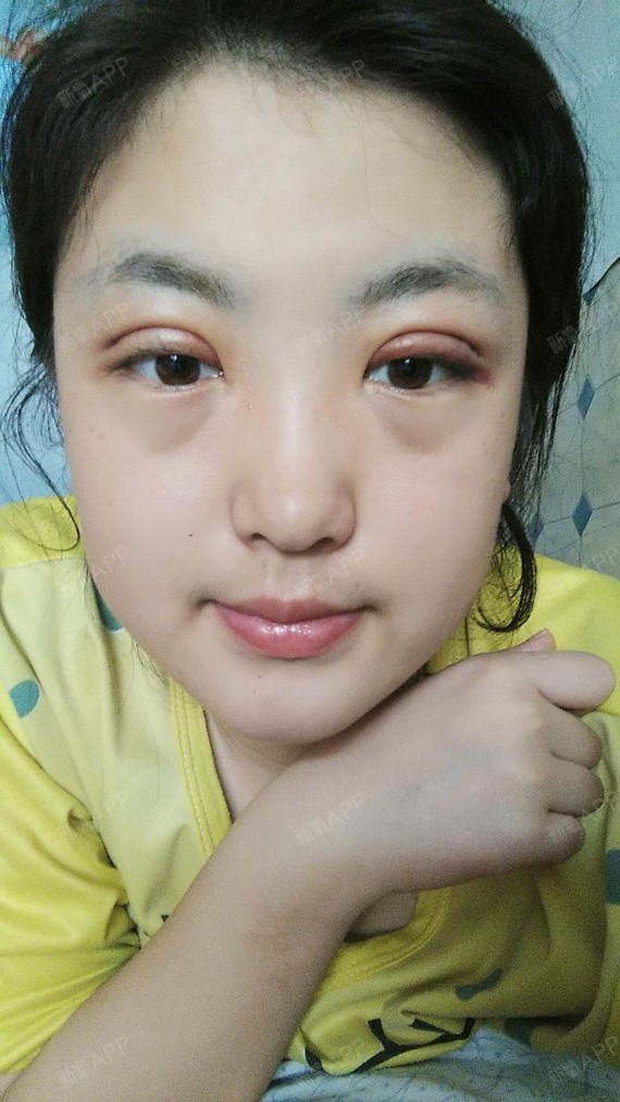 眼部 | 术后当自强 | 北京同城 | 双鸭山同城 | 眼部综合 | 眼部