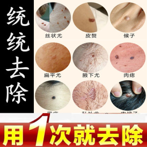 治祛去除脖子腋下小肉粒丝肉疙瘩的药皮肤颈部皮赘肉瘤疣软膏液痣