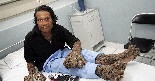 全球五种怪异病魔