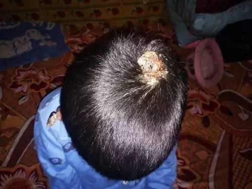 海原13岁美丽女孩患病变鬼脸,头部生蛆,父亲绝望放弃治疗,命悬一线!