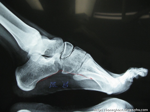 黑线画出的就是足舟骨,姚明骨折的那块骨头.