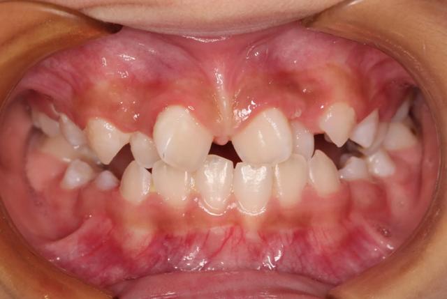 中华医学会的数据显示,中国青少年的错颌畸形(牙齿不齐)发病率很高,但