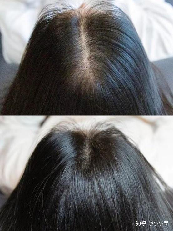 头顶上头发稀疏怎么办?
