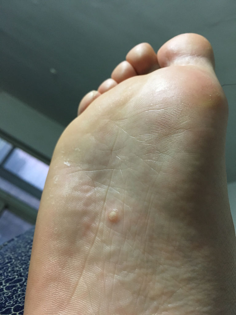 脚上长个小包,刚开始,是一个特别小的小包,现在这么大了,使劲按压,有
