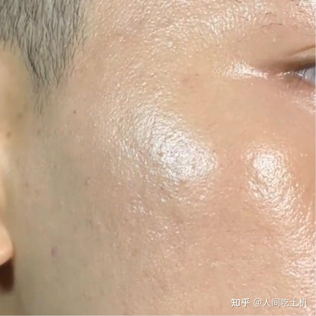 男生毛孔粗大出油长痘怎么护肤用哪些护肤品有效