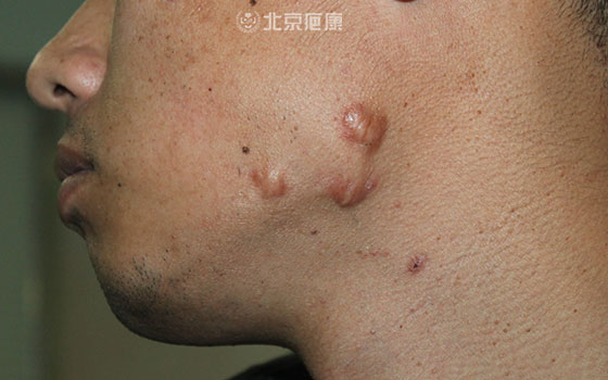 瘢痕疙瘩为什么被称为世界医学难题