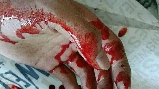 朋友有自残行为,只有我知道,怎么办?