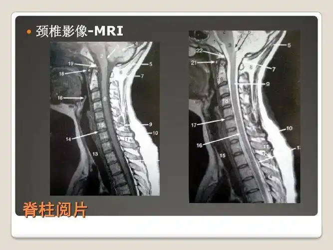 颈椎影像-mri 脊柱阅片