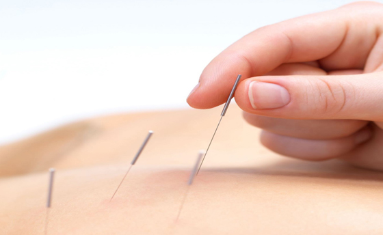 大马中医师及针灸师大多数都使用扎针法治疗病者.