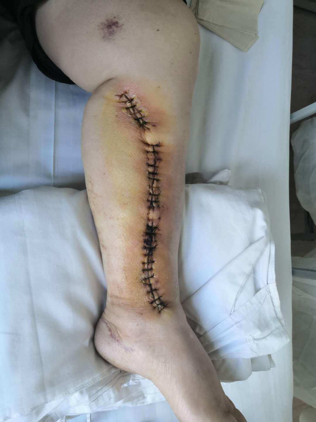 我院完成首例腔镜取桥搭桥手术【技术新突破】