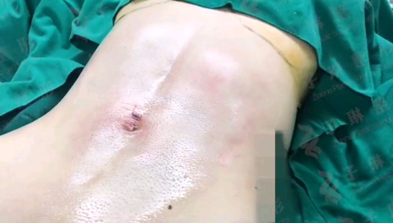 威塑腰腹环吸抽脂术后即刻!