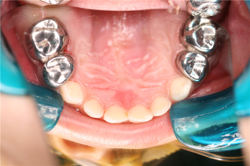 儿童及青少年滞留乳牙及埋伏阻生牙,多生牙,畸形牙等无痛拔除5.