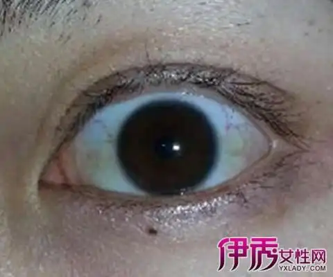 有部分人突然会出现眼白发黄,而且是没有任何预兆的,因此他们都对这种