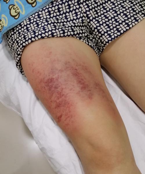 2转载除了中焦以外大腿最容易堵