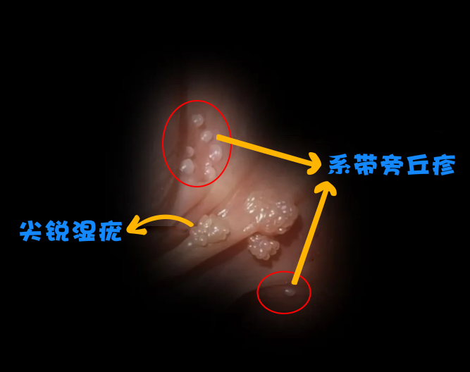 尖锐湿疣和系带旁丘疹都是性病中常见的皮肤问题,但是它们的形态和