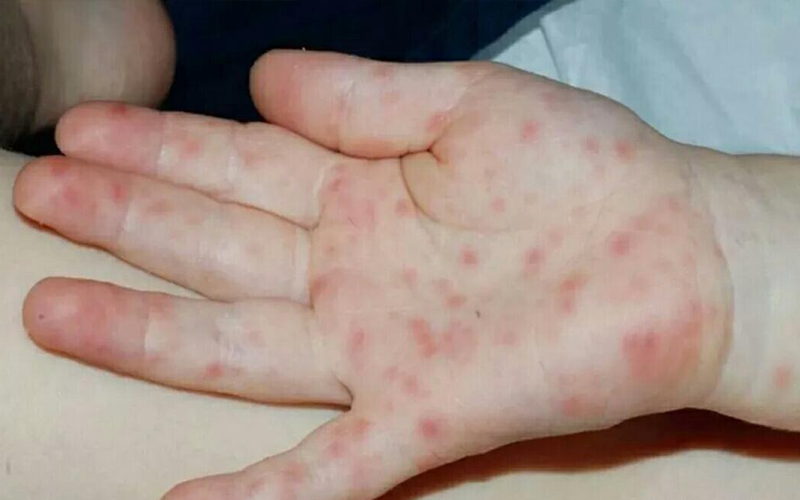 求儿童病毒疹的症状图片