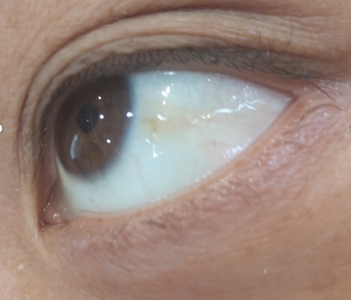 睛护士:眼球发黄怎么办,3个妙招帮你解决_手机搜狐网