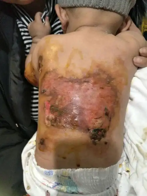 春节临近,郯城县郯城卫生院烧伤和创面处理专科主任史爱国提醒您:呵护