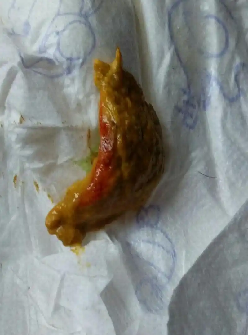 大便黄色,干硬成结,大便表面带血,附着着鲜红色红色的血液,考虑肛裂