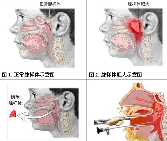 腺样体肥大?扁桃体肥大?