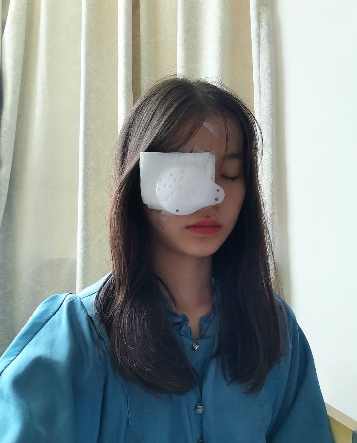 上午做了左眼七月十六号下午到医院做了右眼,第二天早上拆开纱布眼罩