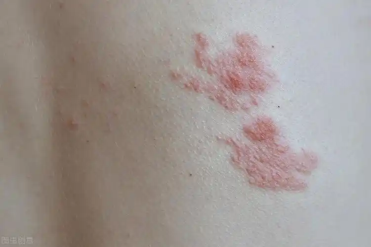 身上长红点还发痒,是过敏?医生:春季水痘高发,及时隔离很重要