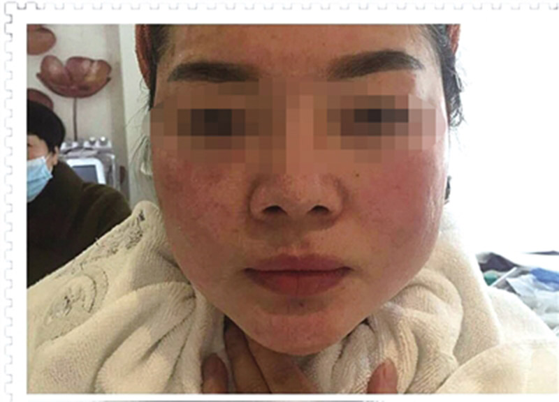 整容变毁容曝光恩施州城一美容院非法行医被没收所得