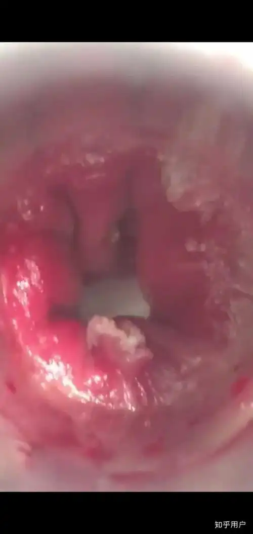 有没有肛内尖锐湿疣治愈的朋友哪种疗法更有效控制复发