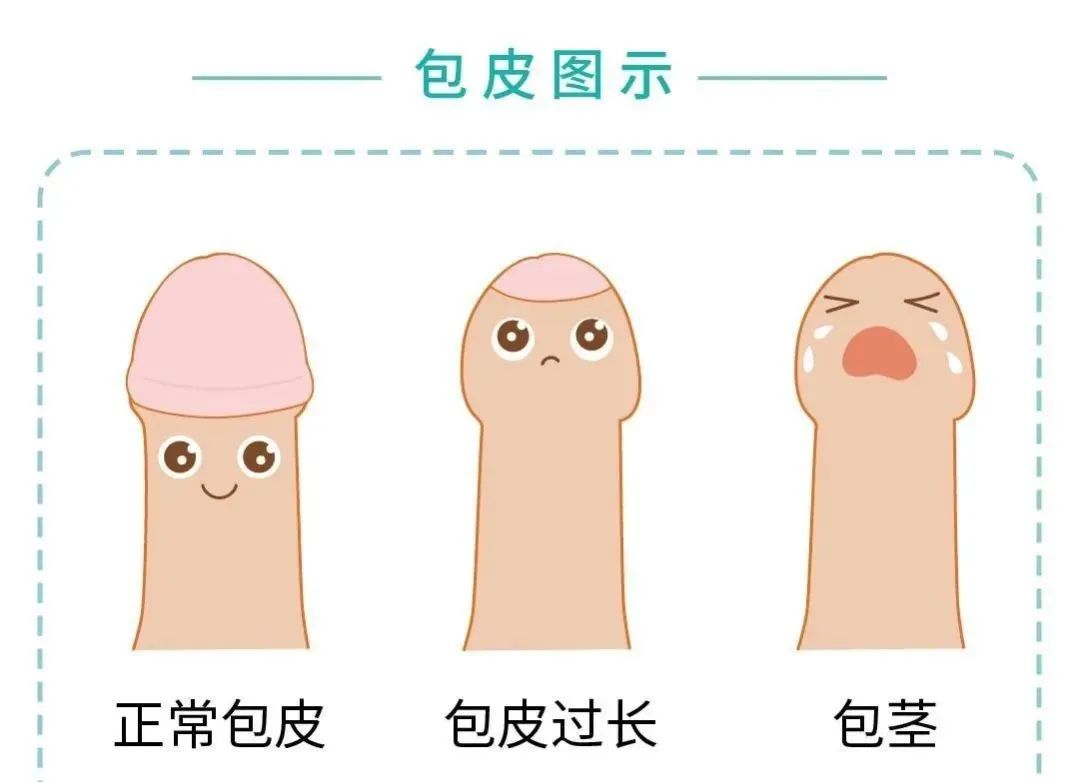 包皮过长和包茎是龟头为包皮所覆盖,原则上说包皮过长可以通过手法将