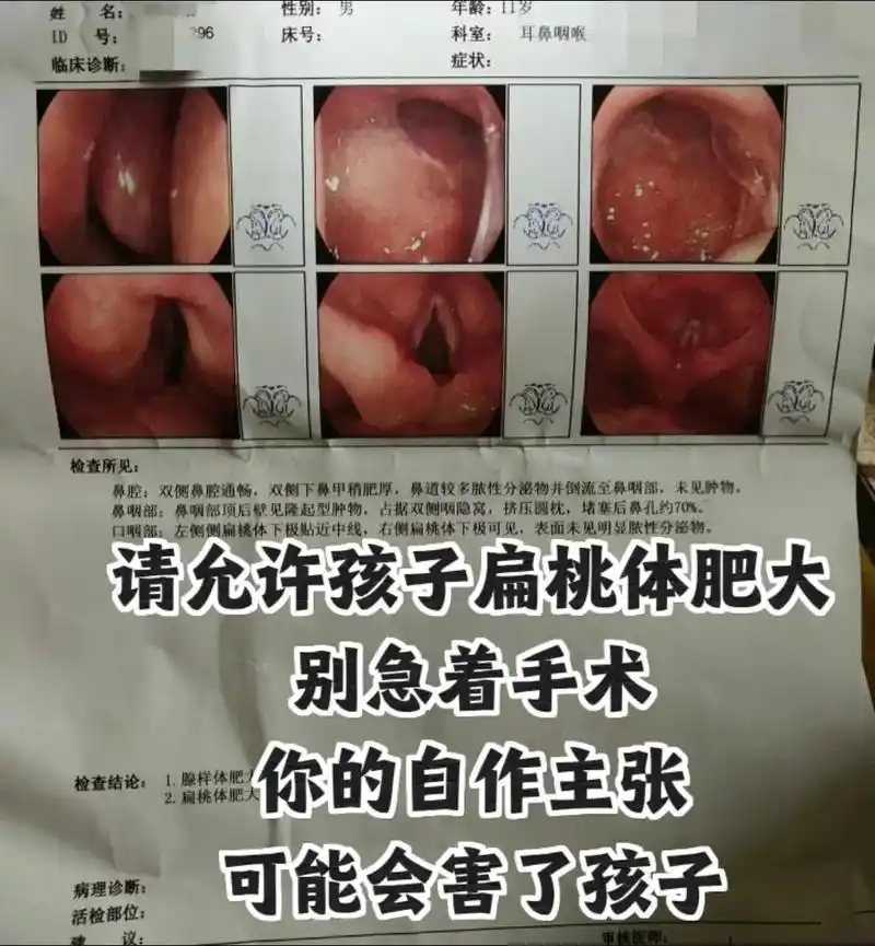 家长们,请允许孩子扁桃体肥大!