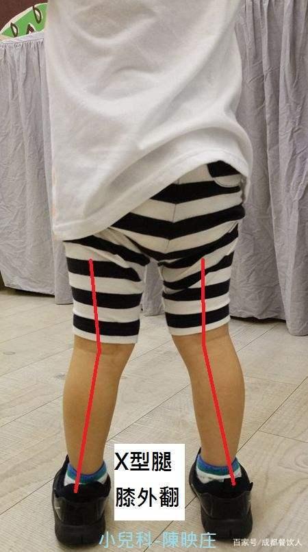 维生素d缺乏引起的x型腿