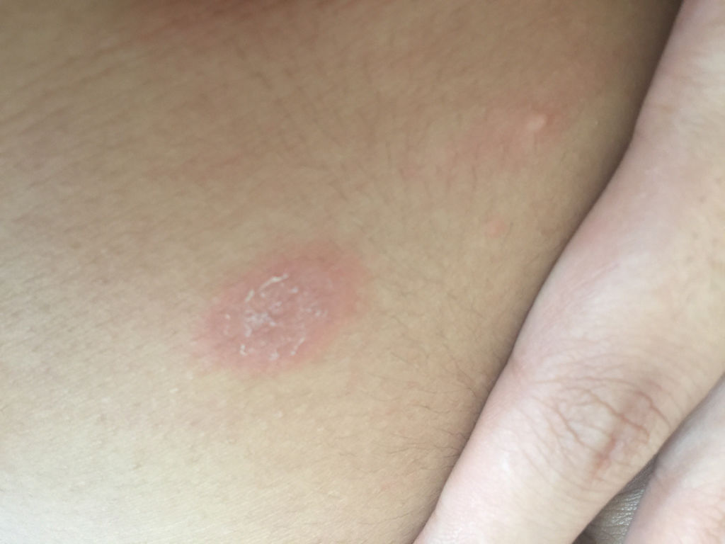 腹部 后背长了很多这个 越来越大 暴皮是梅毒疹子a吗!