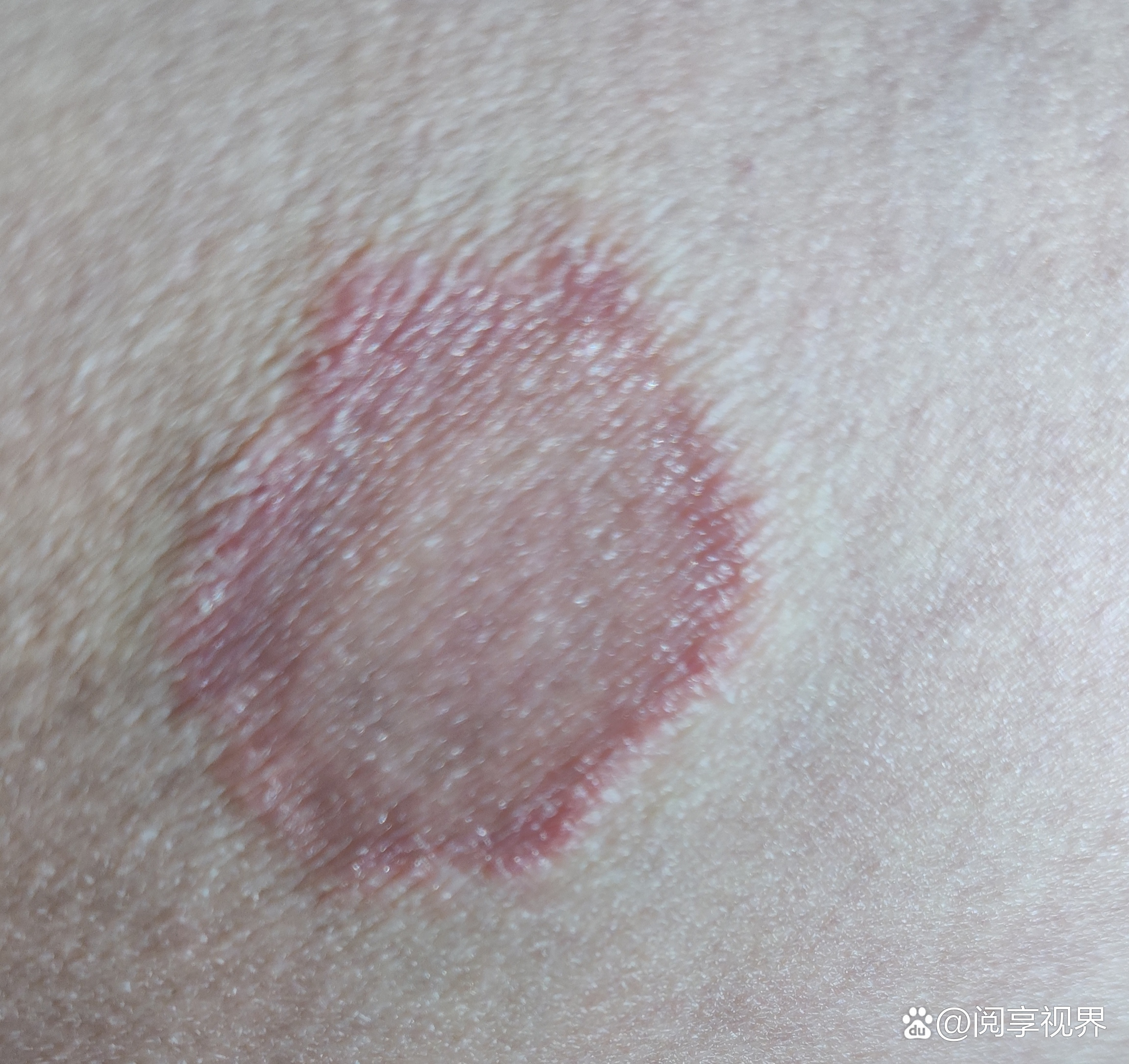 万能的度友们我有难言之隐难以启齿的烦恼,就是这个大腿内侧根部长了