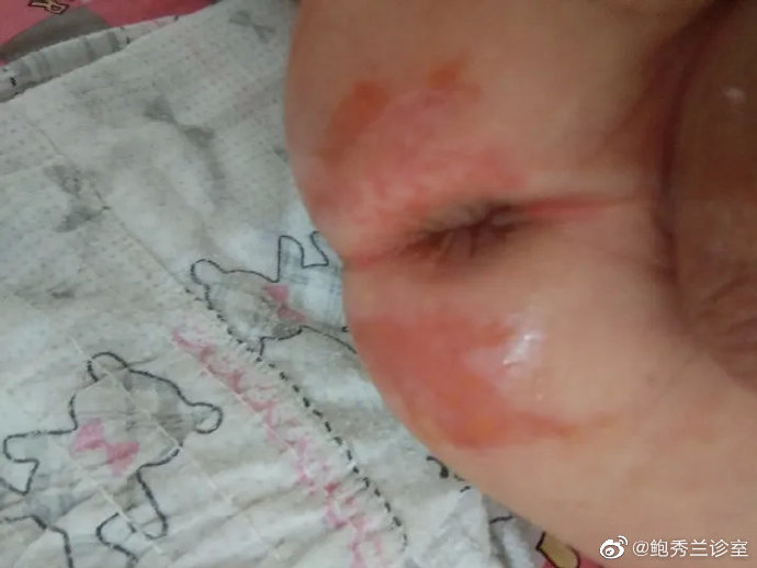 育儿##科普大作战#红屁屁的发生,主要是因为宝宝大,小便给皮肤带来的