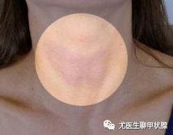 我们该怎么自检甲状腺?