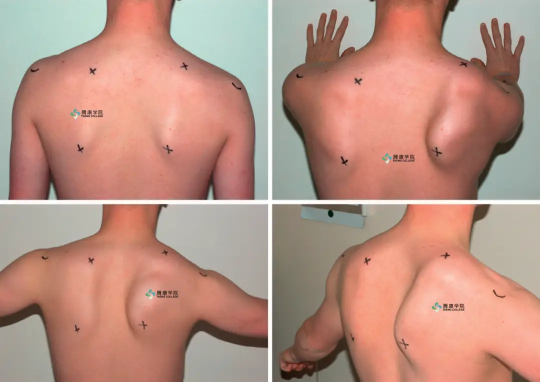 翼状肩原因分析汇总_肩胛骨