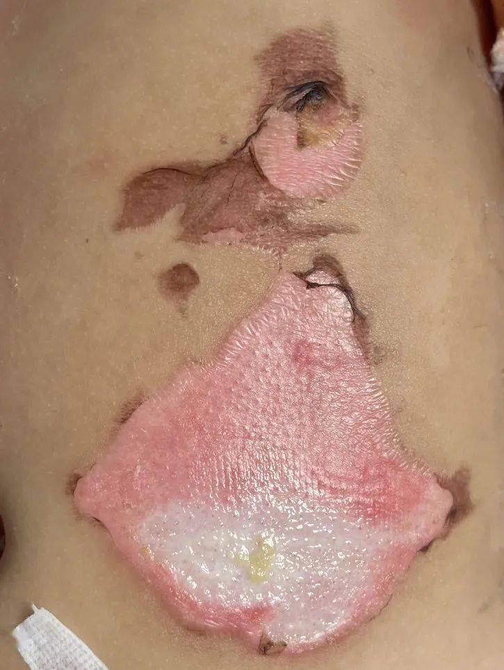 仅7个月大孩子,不慎被开水烫伤左大腿,下腹部,烫伤面积达18%,皮肤红肿