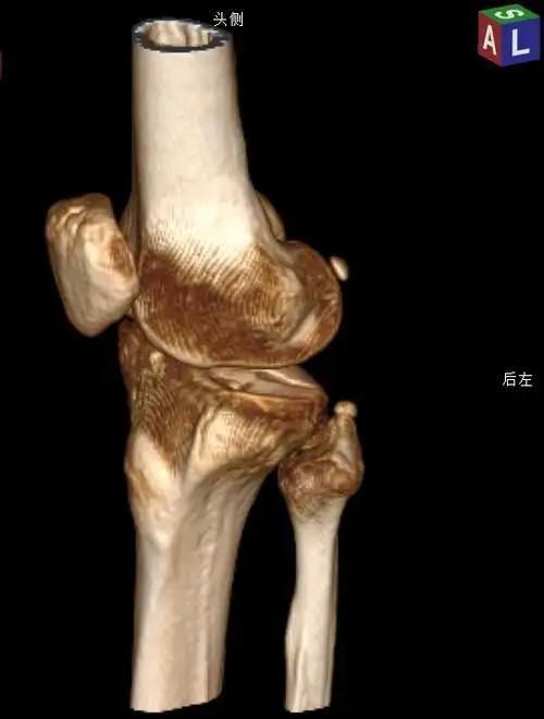 ct 三维示:胫骨外侧平台前侧塌陷,有台阶,外侧平台后侧未骨折.