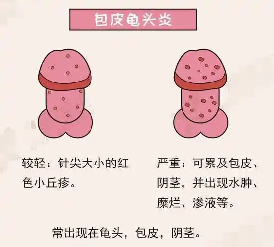 乌龟2024-01-0800阴茎红肿怎么回事 龟头炎多发生于包茎或包皮过长的