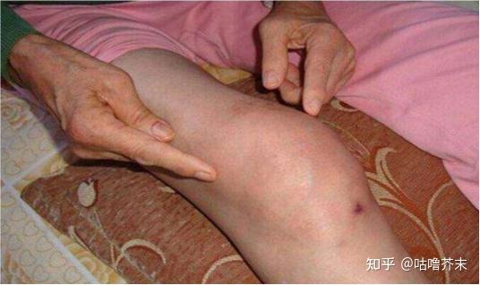 滑膜炎发作疼痛难忍87岁老中医秘方分享消肿止痛膝盖再也不疼