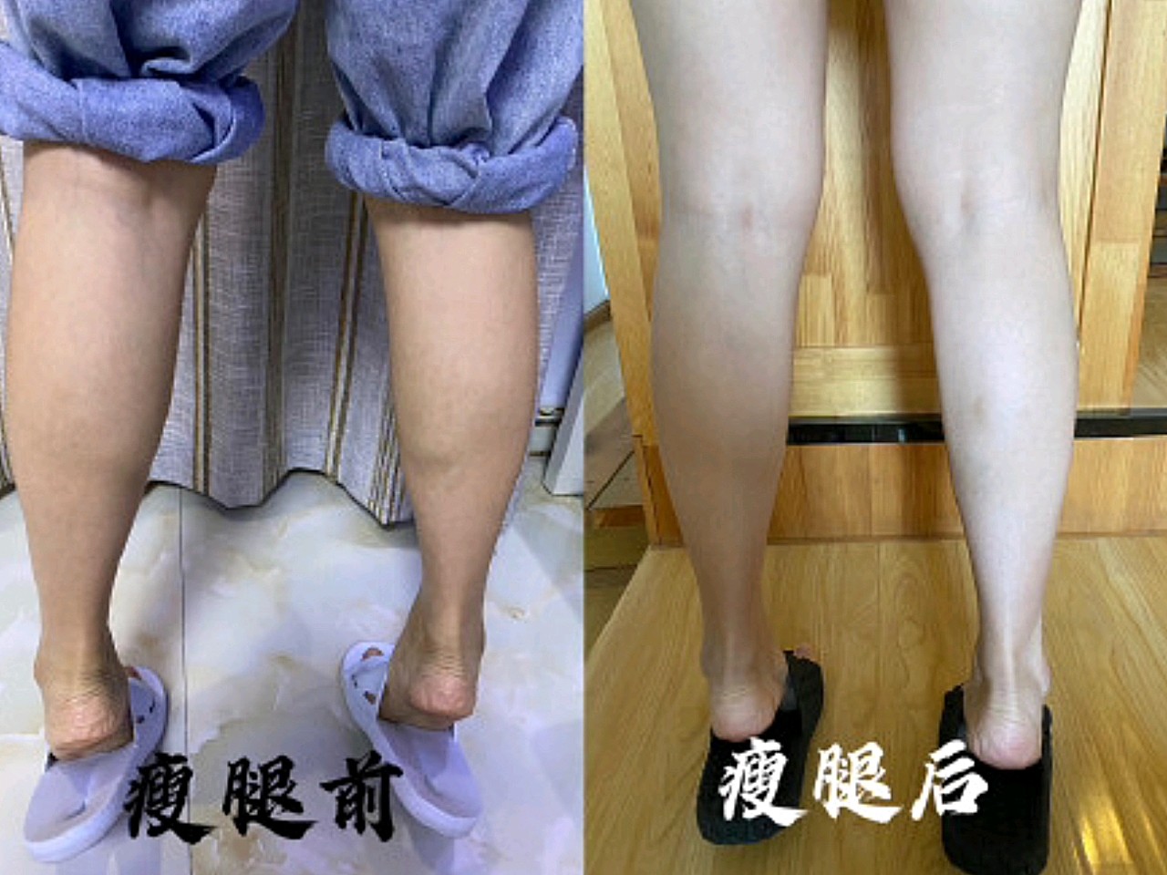 因为一直都想打瘦腿针所以对比了很多家医院,价格都