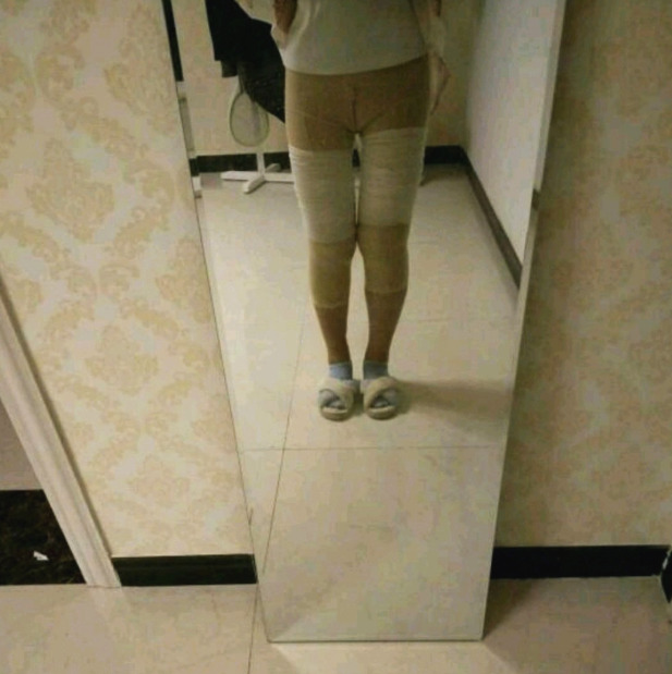 宝妈哺乳后胖了大腿根爆粗水动力大腿环吸术分享附攻略