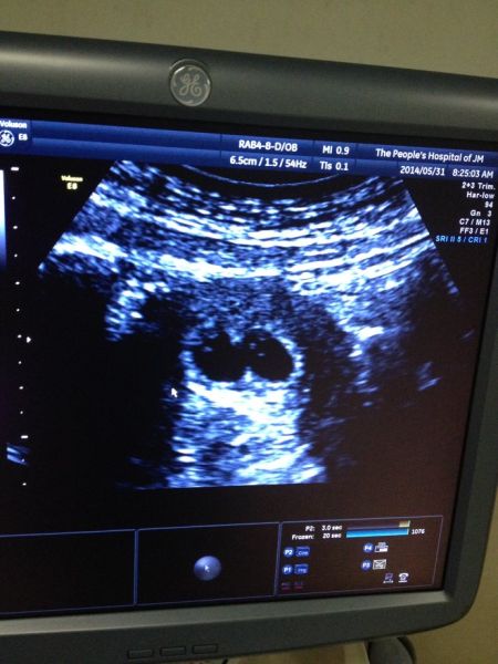 孕9周b超孕12周b超出生第三天,妹妹到儿科观察了两天,终于送回我身边