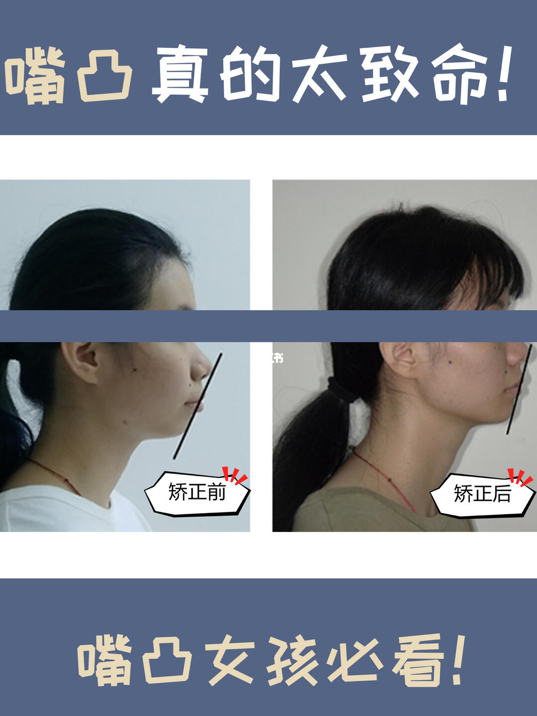 【嘴凸矫正案例】98凸嘴是决定一个人颜值高低的重要因素之一,其对