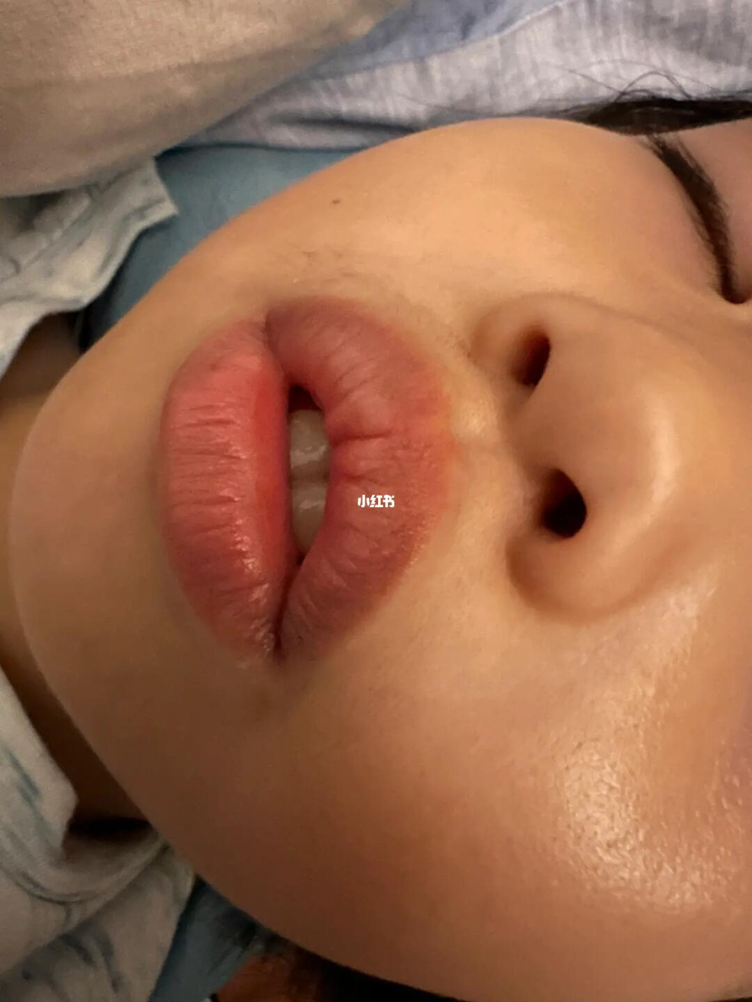 真假腺样体肥大