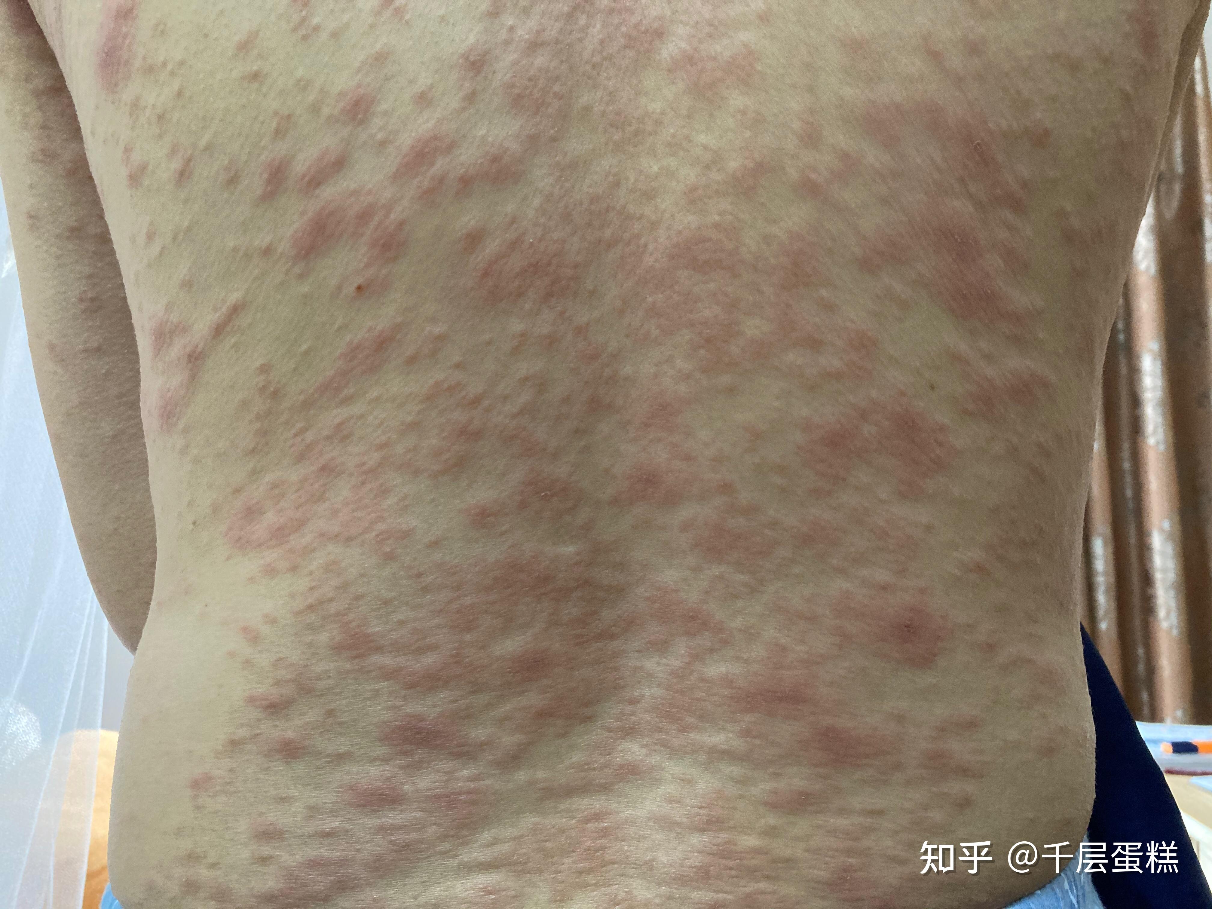 孕中期妊娠特应性皮炎妊娠湿疹的血泪史有图慎入