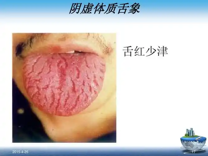 所有分类 初中教育 语文 吴小慧体质与健康课件ppt 阴虚体质舌象 舌红